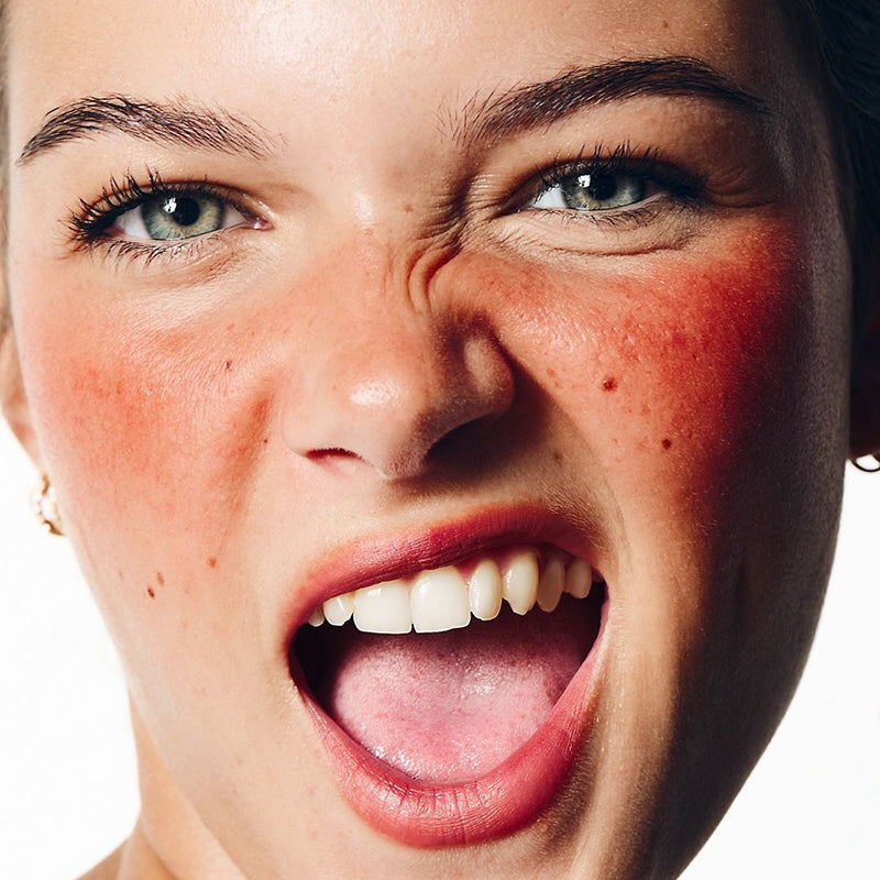 AG SKIN is a partner of a seminar on rosacea treatment