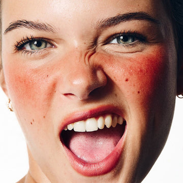 AG SKIN is a partner of a seminar on rosacea treatment
